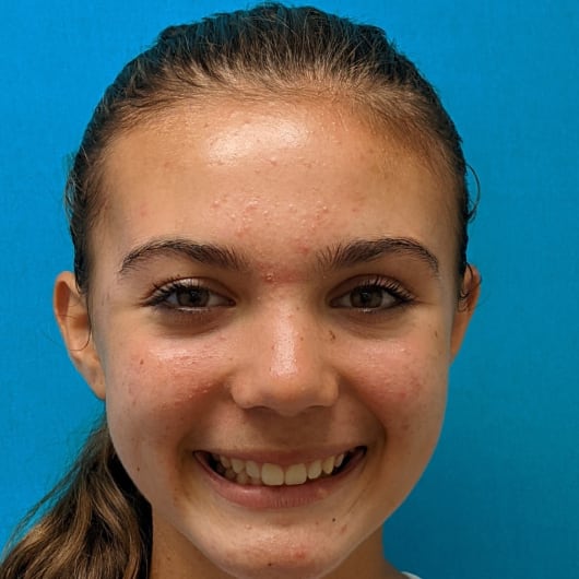 Patient Photo Before Treatment at All Star Smiles Orthodontics