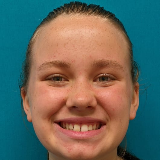 Patient Photo Before Treatment at All Star Smiles Orthodontics