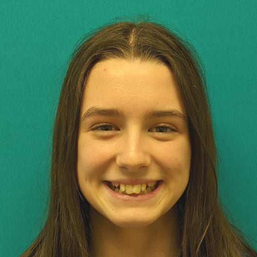 Patient Photo Before Treatment at All Star Smiles Orthodontics