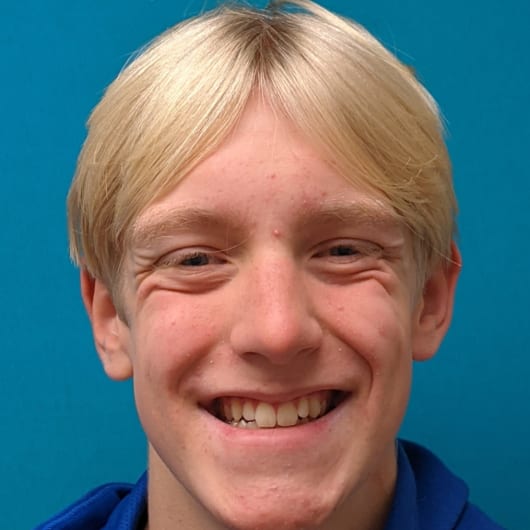 Patient Photo Before Treatment at All Star Smiles Orthodontics