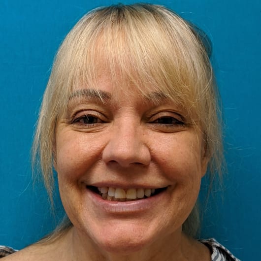 Patient Photo Before Treatment at All Star Smiles Orthodontics