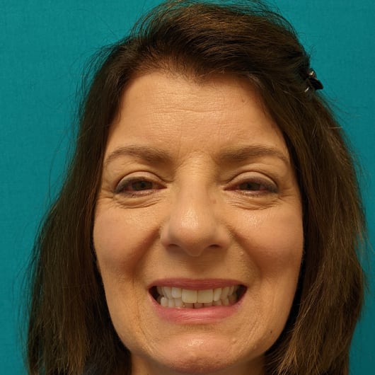 Patient Photo Before Treatment at All Star Smiles Orthodontics