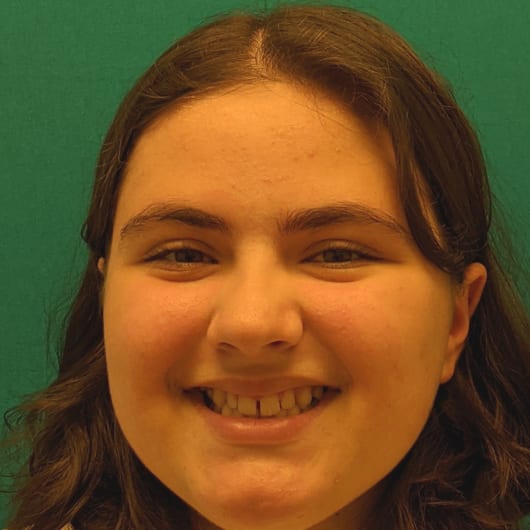 Patient Photo Before Treatment at All Star Smiles Orthodontics