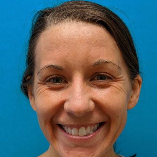 Patient Photo Before Treatment at All Star Smiles Orthodontics