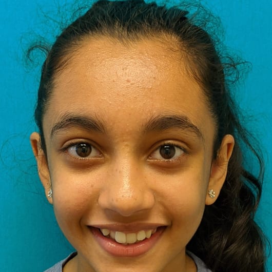 Patient Photo Before Treatment at All Star Smiles Orthodontics
