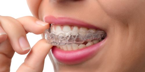 Invisalign in Langley