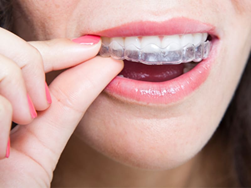 Invisalign, Winnipeg Orthodontist